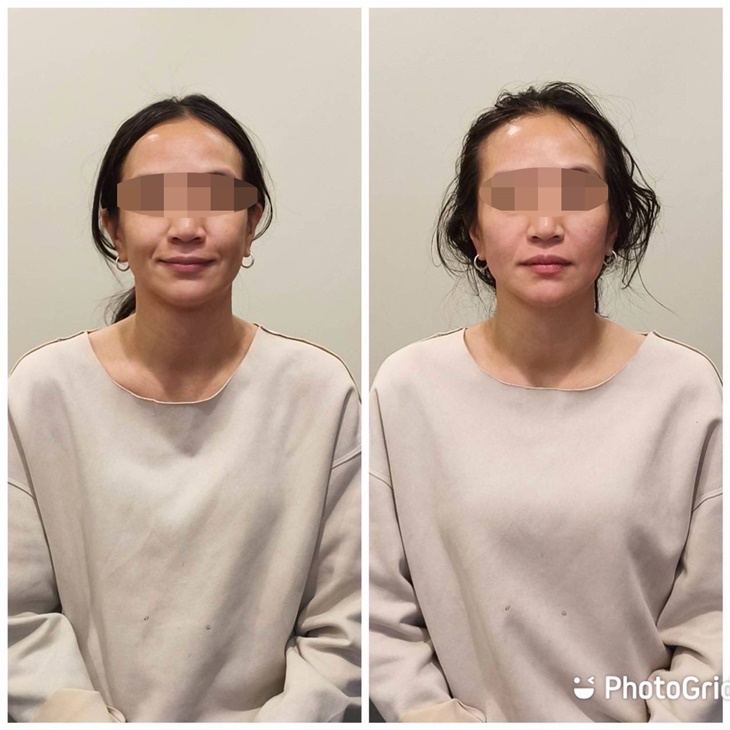 感覺咬合不正嗎？張口卡頓？高低眉不齊/嬰兒肥/大小臉？輕鬆還你漂亮~正位神采飛揚！頭面部筋膜微調術