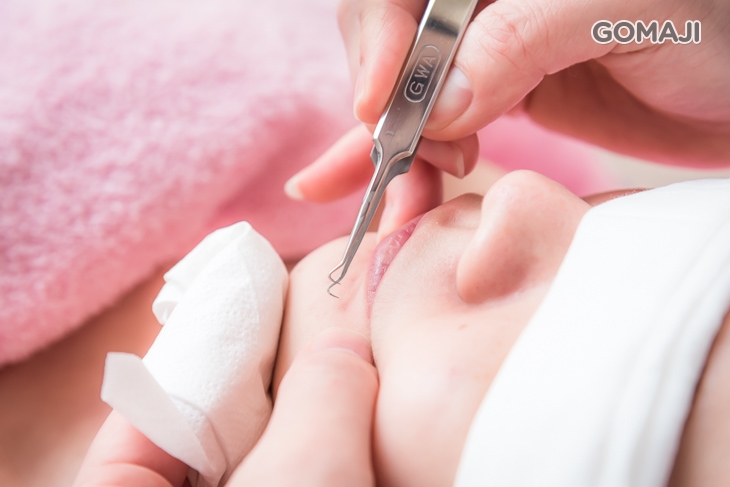 粉刺調理(手工)