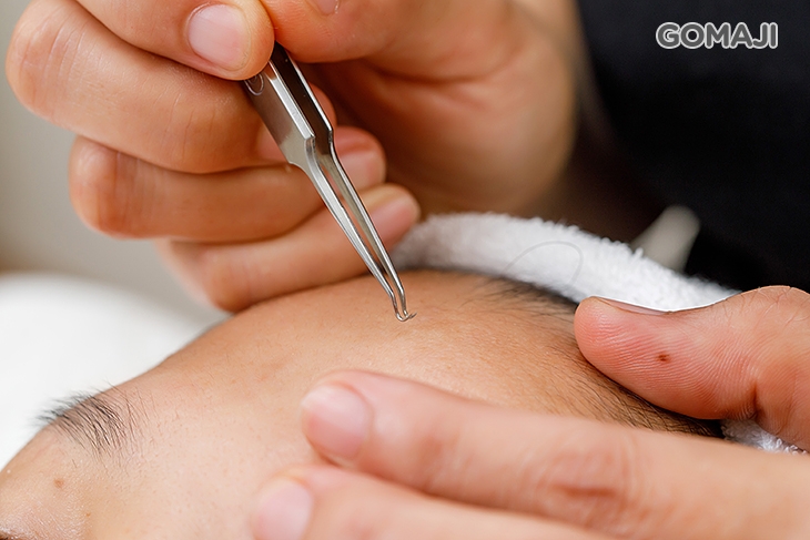 黑頭粉刺痘痘清潔20分(依個人膚況而定)