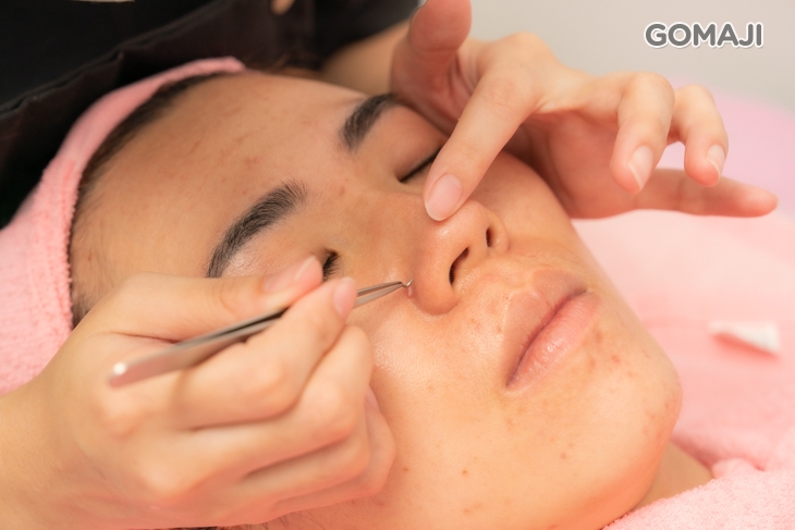 手工粉刺痘痘調理