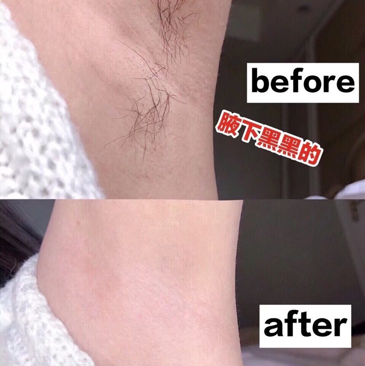 日式低痛除毛腋下+VIO光溜溜懶人包