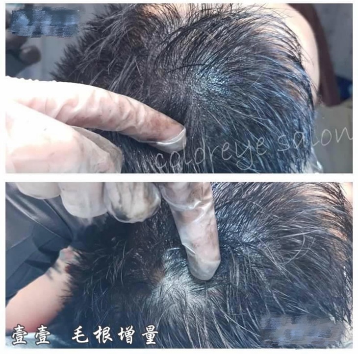 韓式頭皮復密術