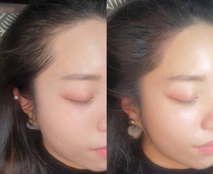 韓式頭皮復密術