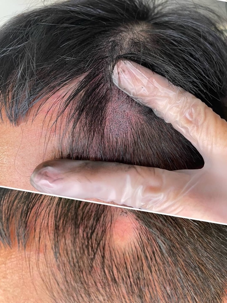 韓式頭皮復密術