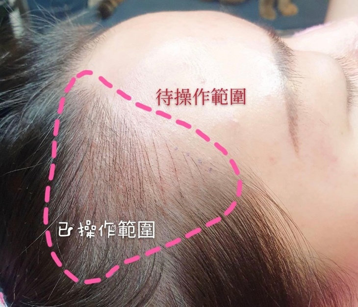 韓式頭皮復密術