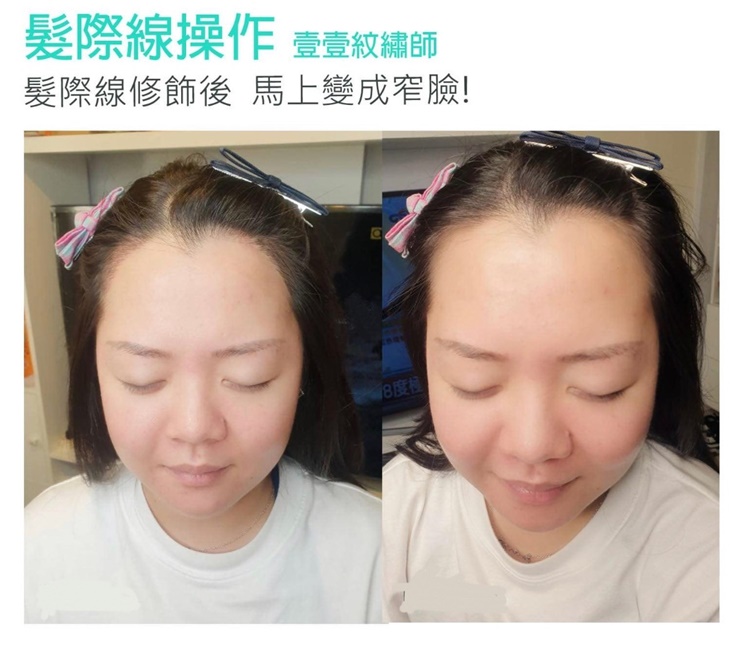 韓式頭皮復密術