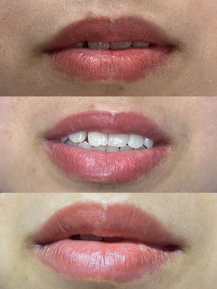 嘴唇黑、唇色暗沉矯正唇色課程