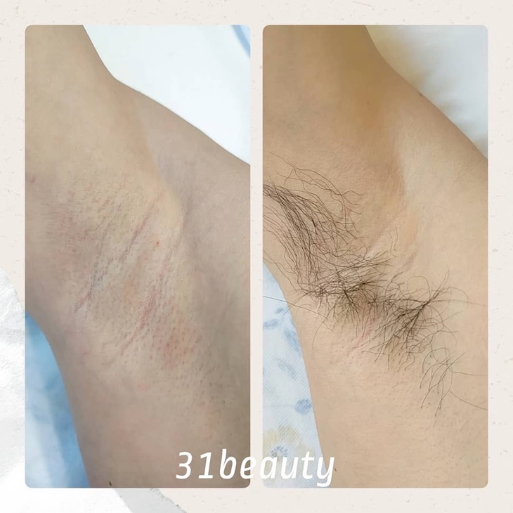 腋下除毛SPA
