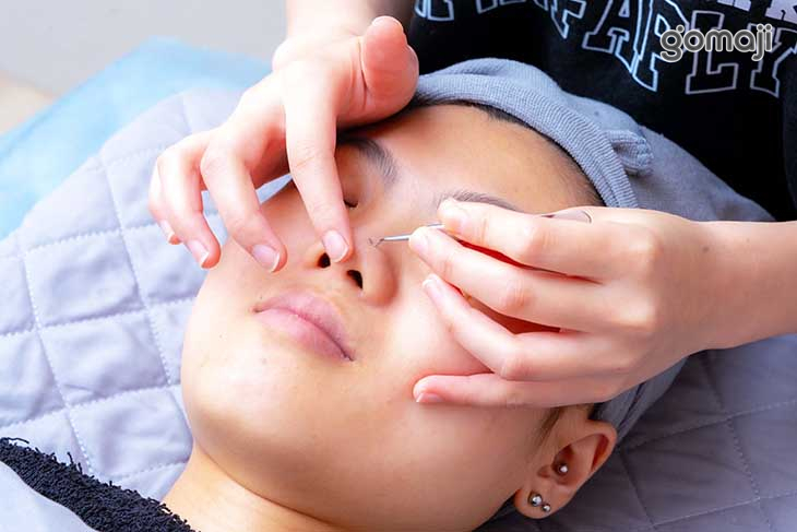 純手工清粉刺、痘痘調理