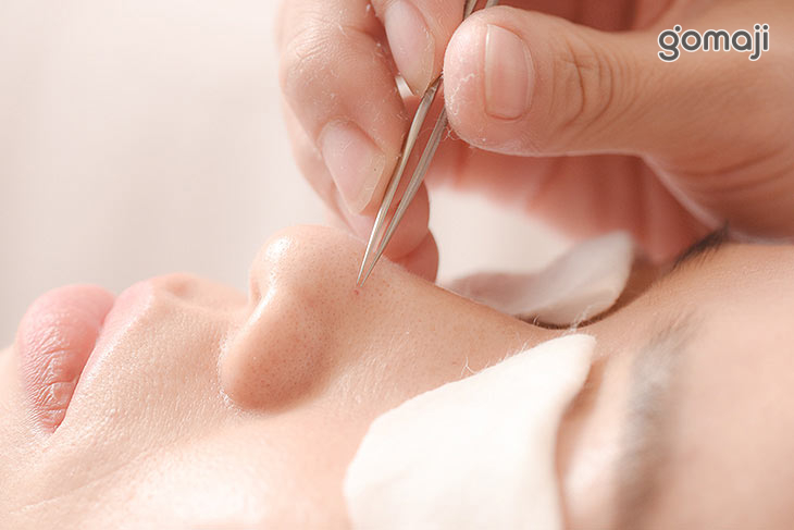 重點手工粉刺痘痘護理