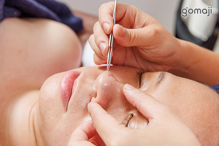 粉刺痘痘清潔調理