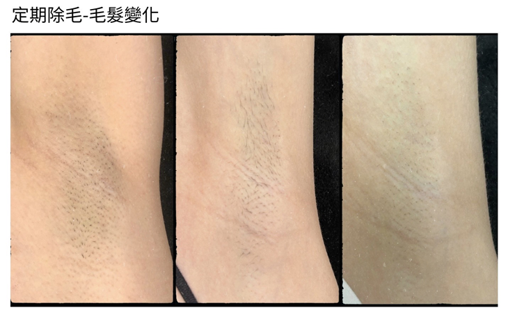 日式冰肌除毛