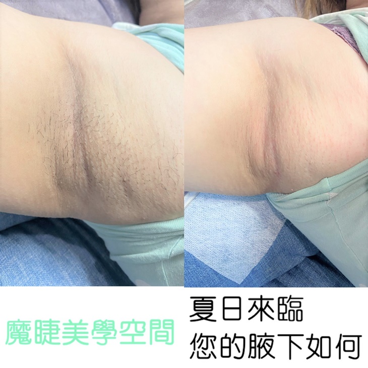 熱蠟除毛