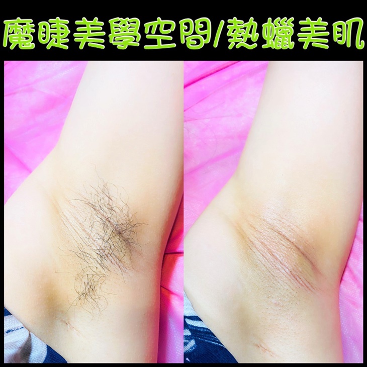 熱蠟除毛