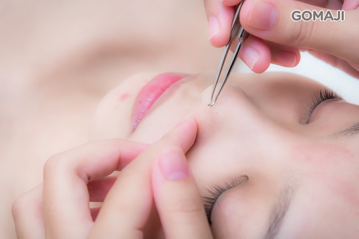 全臉黑頭粉刺痘痘淨化