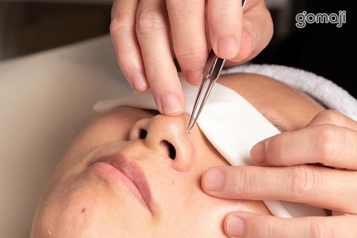 全臉黑頭粉刺痘痘淨化清除