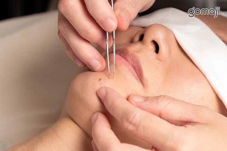 全臉黑頭粉刺痘痘淨化清除