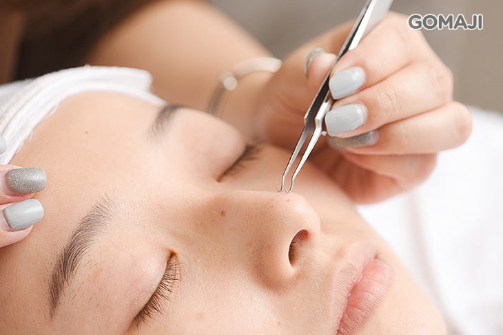 純手技淨化粉刺痘痘調理